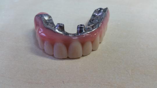 Implant dentures